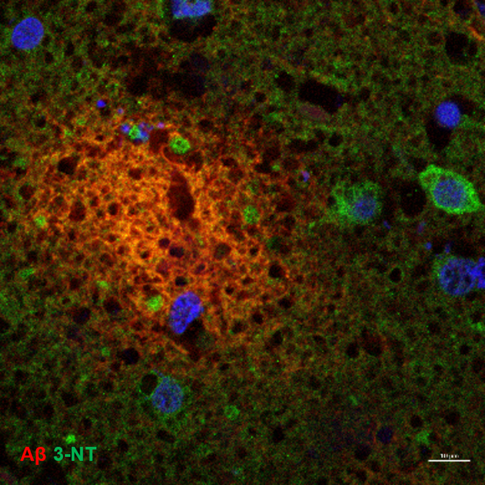 Slika 2. 3-NT v pasjih možganih. 3-NT (zeleno obarvanje) je prisoten v celicah, ki obkrožajo amiloide (Aβ) plake (rdeče obarvanje) pa tudi izven celic v območju plaka. Celična jedra so obarvana modro. Prikazan je čelni reženj 16 letnega jazbečarja s kognitivno motnjo. Merilo je dolgo 10 µm.