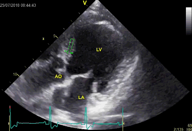 Video 3: Subvalvular (arrow) and valvular aortic stenosis in a dog