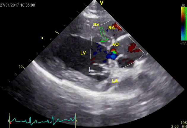 Video 4: Subvalvular lesion (arrow) is obstructing aortic outflow in a dog with subaortic stenosis, causing turbulent flow in aorta